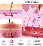 Inflammation